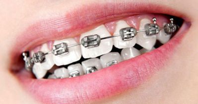 Braces-Orthodontics